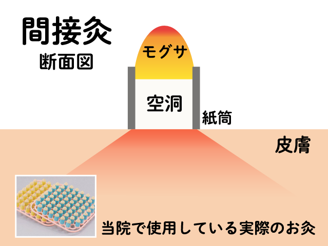 当院で使っているお灸